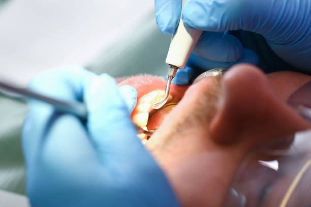 Best Emergency Dentist for Lost Fillings or Crowns in Stone Ridge, VA
